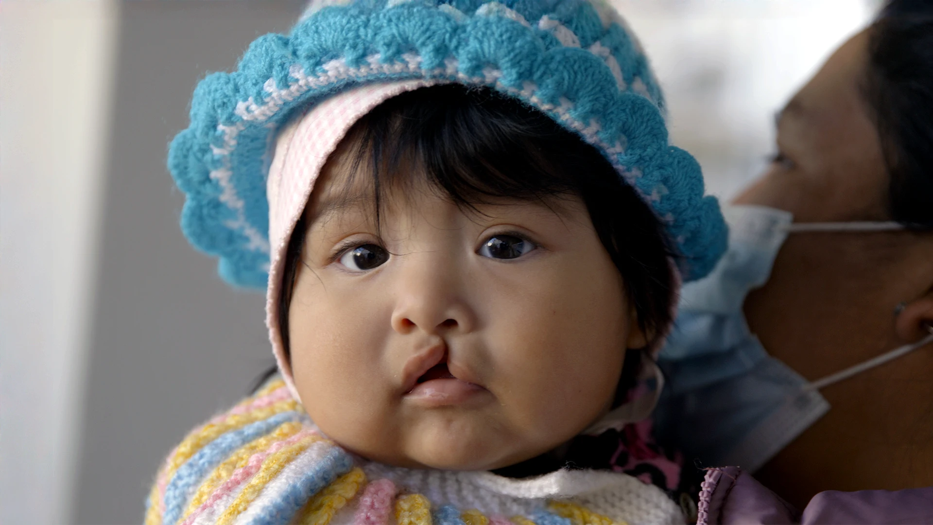 A child with cleft lip