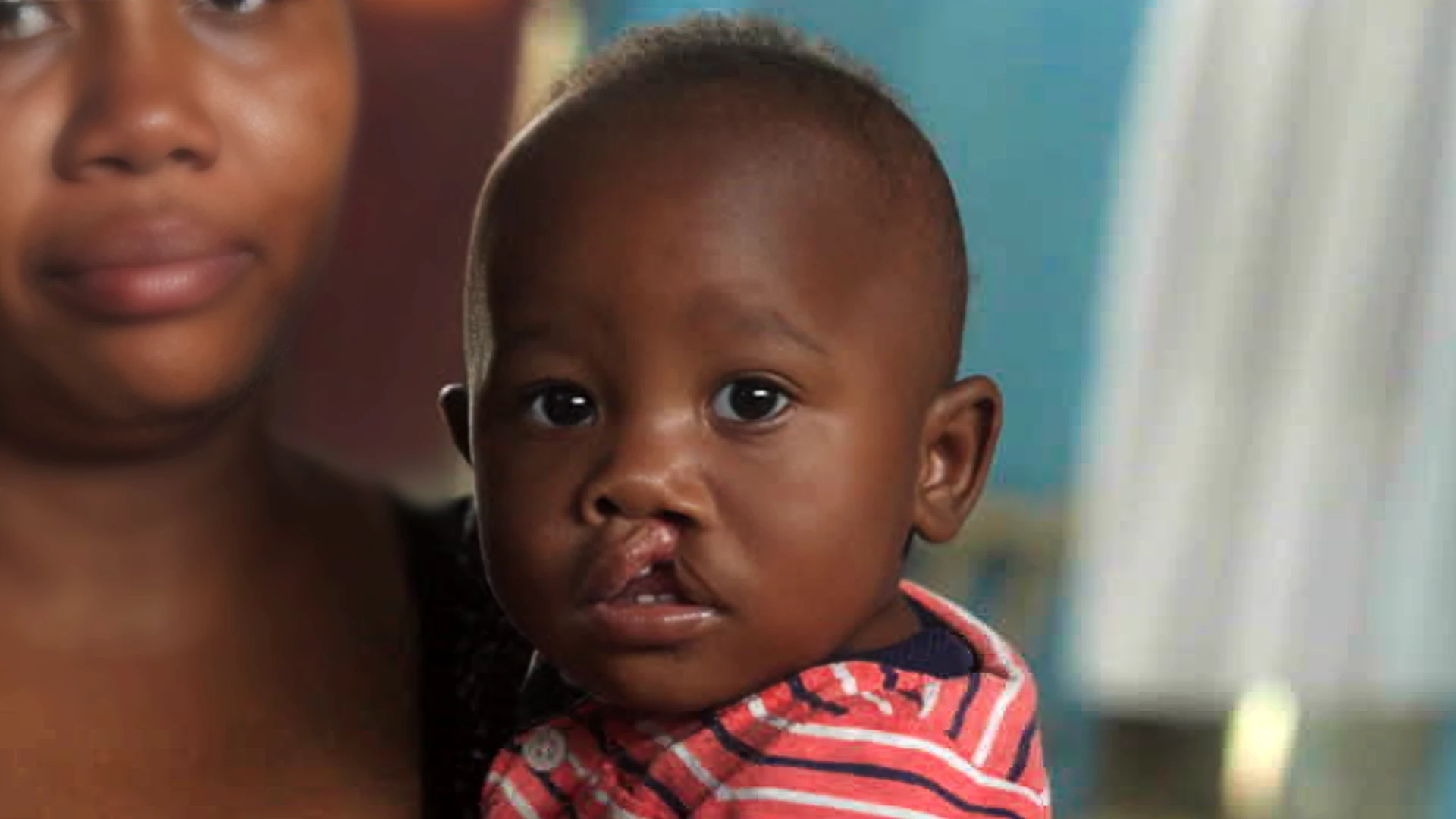 A child with cleft lip