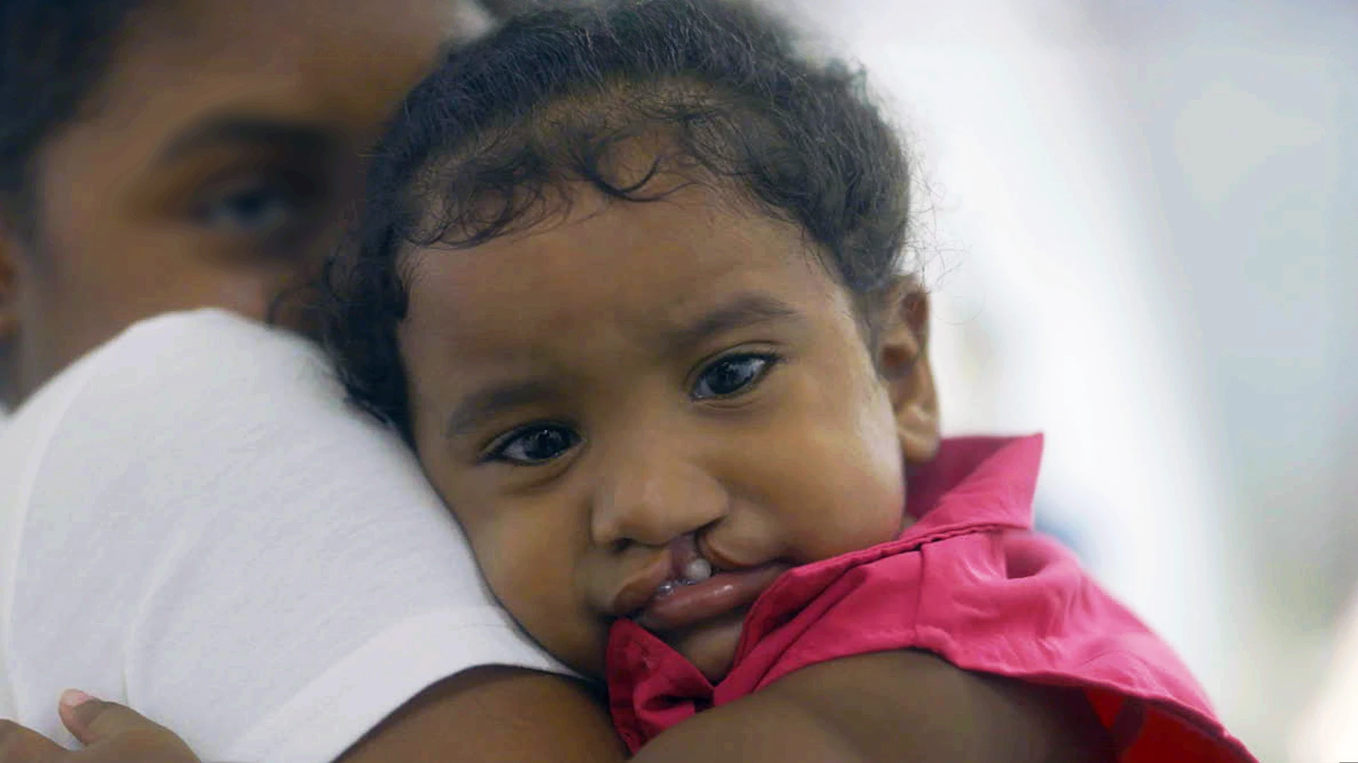 A child with cleft lip